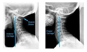 Comparison of two X-ray images showing anterior carriage and proper carriage alignment of the cervical spine.